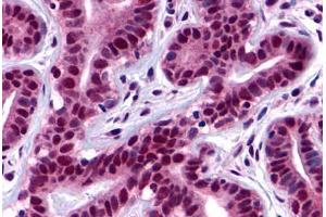 Human Ductal and Lobular Epithelium (formalin-fixed, paraffin-embedded) stained with PTK2 antibody ABIN213433 at 2 ug/ml followed by biotinylated goat anti-rabbit IgG secondary antibody ABIN481713, alkaline phosphatase-streptavidin and chromogen. (FAK Antikörper  (Internal Region))