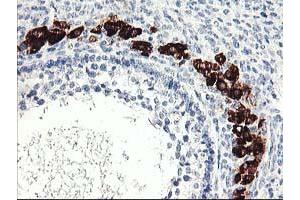 Immunohistochemical staining of paraffin-embedded Adenocarcinoma of Human ovary tissue using anti-PTPN7 mouse monoclonal antibody. (PTPN7 Antikörper)