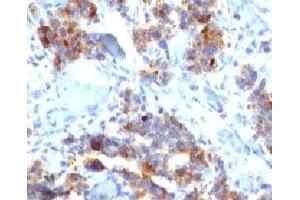 IHC testing of human gastric carcinoma stained with MUC5AC antibody (45M1). (MUC5AC Antikörper)