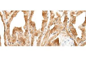 Immunohistochemistry of paraffin-embedded Human thyroid cancer tissue using ZPBP Polyclonal Antibody at dilution of 1:30(x200) (ZPBP Antikörper)