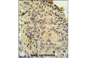 RSPO2 Antibody (C-term) (ABIN651457 and ABIN2840250) immunohistochemistry analysis in formalin fixed and paraffin embedded human lung carcinoma followed by peroxidase conjugation of the secondary antibody and DAB staining. (RSPO2 Antikörper  (C-Term))