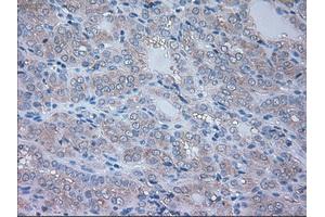 Immunohistochemical staining of paraffin-embedded Carcinoma of thyroid tissue using anti-NRBP1mouse monoclonal antibody. (NRBP1 Antikörper)