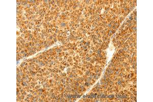 Immunohistochemistry of Human liver cancer using DIABLO Polyclonal Antibody at dilution of 1:70