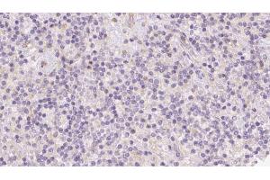 ABIN6273094 at 1/100 staining Human lymph cancer tissue by IHC-P. (BCO2 Antikörper  (Internal Region))
