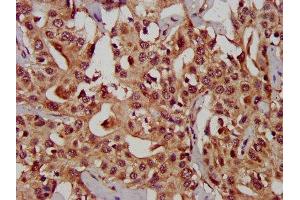 IHC image of ABIN7146680 diluted at 1:300 and staining in paraffin-embedded human liver cancer performed on a Leica BondTM system. (CHST11 Antikörper  (AA 214-330))