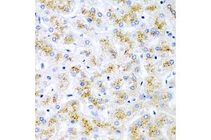 Immunohistochemistry of paraffin-embedded human liver injury using WNT2 antibody (ABIN5973475) at dilution of 1/200 (40x lens). (WNT2 Antikörper)