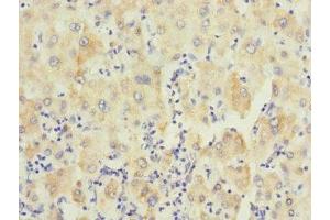 Immunohistochemistry of paraffin-embedded human liver cancer using ABIN7174120 at dilution of 1:100 (PTPN7 Antikörper  (AA 1-190))