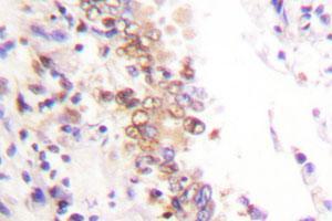 Immunohistochemical analysis of paraffin-embedded human lung cancer tissue using PIAS1 polyclonal antibody . (PIAS1 Antikörper)
