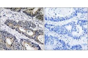 Immunohistochemistry analysis of paraffin-embedded human colon carcinoma, using GLB1L3 Antibody. (GLB1L3 Antikörper  (AA 291-340))