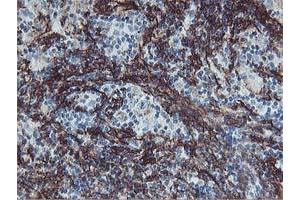 Immunohistochemical staining of paraffin-embedded Human lymphoma tissue using anti-VCAM1 mouse monoclonal antibody. (VCAM1 Antikörper)