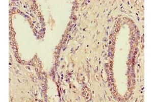 Immunohistochemistry of paraffin-embedded human prostate cancer using ABIN7164562 at dilution of 1:100 (ZDHHC1 Antikörper  (AA 283-389))