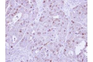 IHC-P Image Immunohistochemical analysis of paraffin-embedded NCIN87 Xenograft, using cyclin A , antibody at 1:500 dilution. (Cyclin A Antikörper)