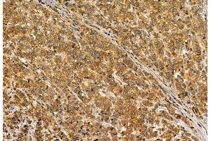 ABIN6264901 and ABIN6272886 at 1/100 staining Human breast cancer by IHC-P. (S100A14 Antikörper  (N-Term))
