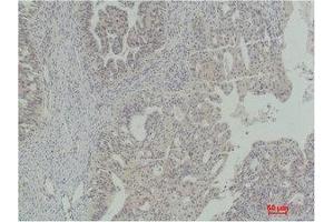 Immunohistochemistry (IHC) analysis of paraffin-embedded Human Ovarian Carcinoma using Stat5a Polyclonal Antibody. (STAT5A Antikörper)