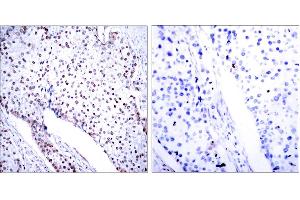 Immunohistochemistry analysis of paraffin-embedded human breast carcinoma tissue, using STAT3 (Ab-705) Antibody. (STAT3 Antikörper)