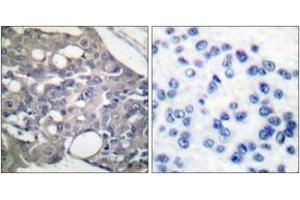 Immunohistochemistry analysis of paraffin-embedded human breast carcinoma, using SHP-1 (Phospho-Tyr536) Antibody. (SHP1 Antikörper  (pTyr536))