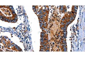 Immunohistochemistry of paraffin-embedded Human colon cancer tissue using ITGA7 Polyclonal Antibody at dilution 1:35 (ITGA7 Antikörper)