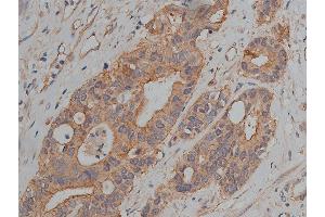 ABIN6269036 at 1/200 staining human colon cancer tissue sections by IHC-P. (JUP Antikörper  (C-Term))