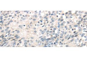 Immunohistochemistry of paraffin-embedded Human ovarian cancer using IQGAP2 Polyclonal Antibody at dilution of 1/40 (IQGAP2 Antikörper)