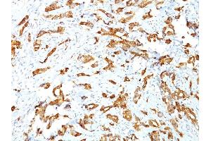 Formalin-fixed, paraffin-embedded human Breast Carcinoma stained with HSP27 Monoclonal Antibody (G3. (HSP27 Antikörper)