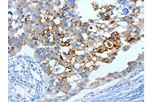 The image on the left is immunohistochemistry of paraffin-embedded Human breast cancer tissue using ABIN7130299(MUC15 Antibody) at dilution 1/25, on the right is treated with fusion protein. (MUC15 Antikörper)