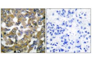 Immunohistochemical analysis of paraffin-embedded human breast carcinoma tissue using Keratin 19 antibody (ABIN5976439). (Cytokeratin 19 Antikörper  (Internal Region))