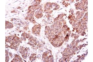 IHC-P Image EIF4E2 antibody [N1C3] detects EIF4E2 protein at cytoplasm on human breast carcinoma by immunohistochemical analysis. (EIF4E2 Antikörper)
