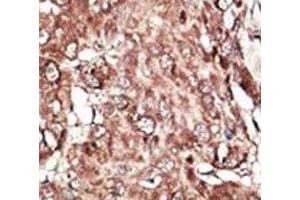 IHC analysis of FFPE human hepatocarcinoma stained with the PRMT7 antibody (PRMT7 Antikörper  (AA 1-30))