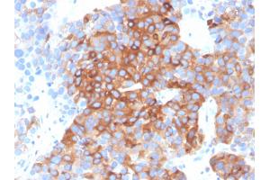 Formalin-fixed, paraffin-embedded human bladder carcinoma stained with Tubulin beta 3 Mouse Monoclonal Antibody (TUBB3/3732). (TUBB3 Antikörper  (AA 437-450))