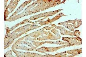 Immunohistochemistry of paraffin-embedded human prostate cancer using ABIN7151465 at dilution of 1:100 (GCN2 Antikörper  (AA 1-300))