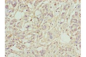 Immunohistochemistry of paraffin-embedded human pancreatic cancer using ABIN7163613 at dilution of 1:100 (PLA2G7 Antikörper  (AA 49-441))