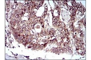 Immunohistochemical analysis of paraffin-embedded human esophageal cancer tissues using PDK2 mouse mAb with DAB staining.