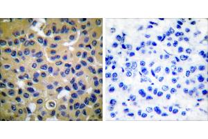 Peptide - +Immunohistochemical analysis of paraffin-embedded human breast carcinoma tissue using Collagen II antibody (#C0155). (COL2 Antikörper)