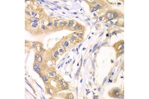 Immunohistochemistry of paraffin-embedded human liver cancer using HAGH antibody (ABIN5973978) at dilution of 1/100 (40x lens). (HAGH Antikörper)