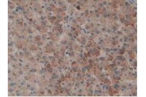 IHC-P analysis of Human Liver Cancer Tissue, with DAB staining. (PLAT Antikörper  (AA 36-126))