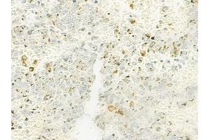 ABIN6263234 and ABIN6272659 at 1/100 staining human melanoma by IHC-P.