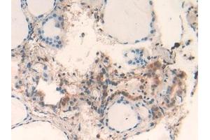 Detection of GAL2 in Human Thyroid Tissue using Polyclonal Antibody to Galectin 2 (GAL2) (Gallinacin-2 (GAL2) (AA 1-132) Antikörper)