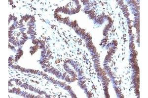 Formalin-fixed, paraffin-embedded human ovarian carcinoma stained with EMI1 antibody (EMI1/1176). (FBXO5 Antikörper  (AA 1-250))