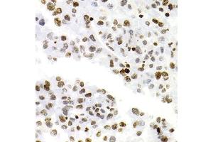 Immunohistochemistry of paraffin-embedded human liver cancer using NFKB2 Antibody (ABIN1873900) at dilution of 1:100 (40x lens). (NFKB2 Antikörper)