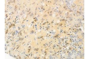 ABIN6255267 and ABIN6267477 at 1/100 staining human melanoma by IHC-P. (beta Catenin Antikörper  (pSer37))