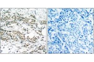Immunohistochemistry analysis of paraffin-embedded human breast carcinoma, using AFX (Phospho-Ser197) Antibody.