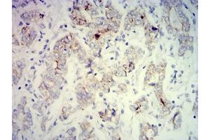 Immunohistochemical analysis of paraffin-embedded stomach cancer tissues using PCK2 mouse mAb with DAB staining. (PEPCK Antikörper  (AA 44-175))