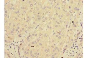 Immunohistochemistry of paraffin-embedded human liver cancer using ABIN7165964 at dilution of 1:100