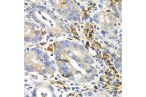 Immunohistochemistry of paraffin-embedded human gastric cancer using AIMP1 antibody. (AIMP1 Antikörper)