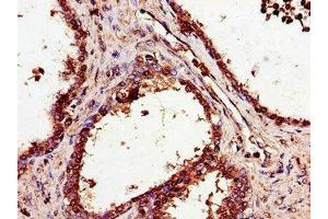 Immunohistochemistry of paraffin-embedded human prostate cancer using ABIN7170549 at dilution of 1:100 (SMS Antikörper  (AA 16-191))