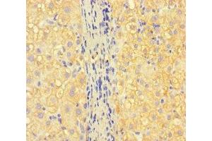 Immunohistochemistry of paraffin-embedded human liver cancer using ABIN7157130 at dilution of 1:100 (ISPD Antikörper  (AA 1-264))
