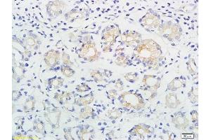 Formalin-fixed and paraffin embedded human gastric cancer labeled with Anti-ING1/p33 Polyclonal Antibody, Unconjugated (ABIN674514) followed by conjugation to the secondary antibody and DAB staining (ING1 Antikörper  (AA 301-422))