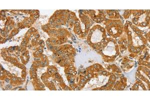 Immunohistochemistry of paraffin-embedded Human thyroid cancer tissue using PDP1 Polyclonal Antibody at dilution 1:30 (PDP Antikörper)