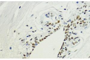 Immunohistochemistry of paraffin-embedded Human breast using DiMethyl-Histone H3-K36 Polyclonal Antibody at dilution of 1:200 (40x lens). (Histone 3 Antikörper  (2meLys36))