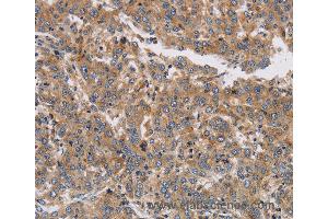 Immunohistochemistry of Human colon cancer using KCNG1 Polyclonal Antibody at dilution of 1:40 (KCNG1 Antikörper)